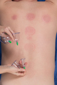 cupping-therapy-cups-removed-renu-madison